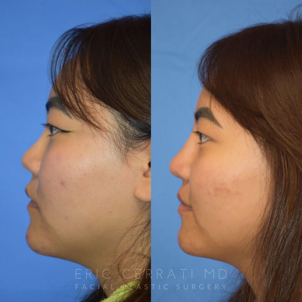 Female patient before and after rhinoplasty