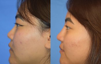 Female patient before and after rhinoplasty