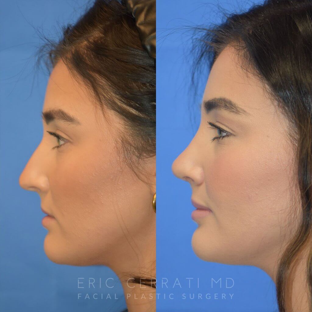 Female patient before and after rhinoplasty