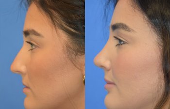 Female patient before and after rhinoplasty