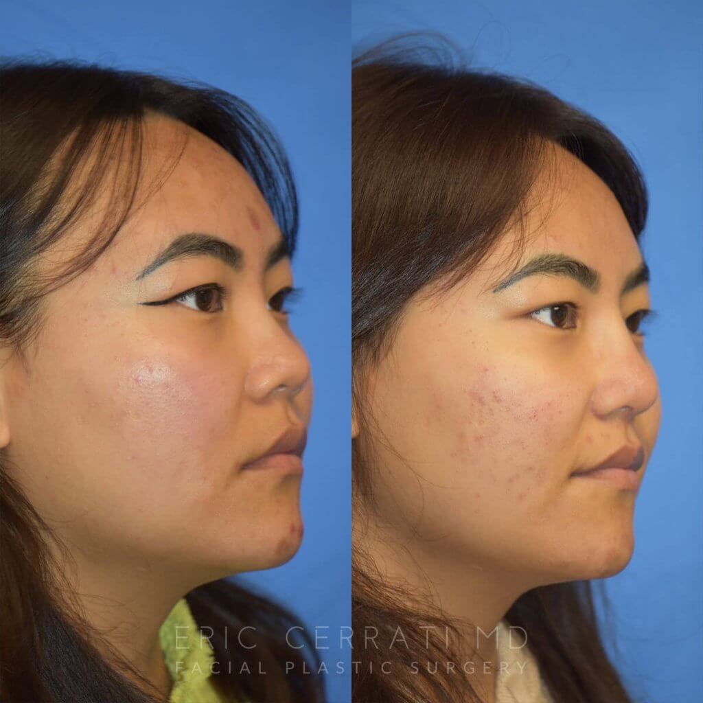 Female patient before and after rhinoplasty