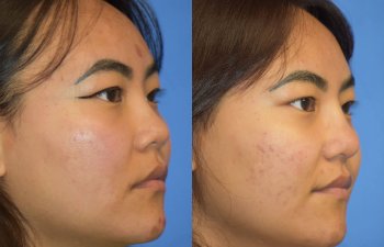 Female patient before and after rhinoplasty