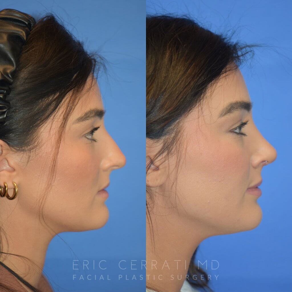 Female patient before and after rhinoplasty