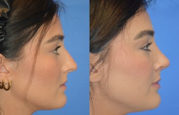 Female patient before and after rhinoplasty