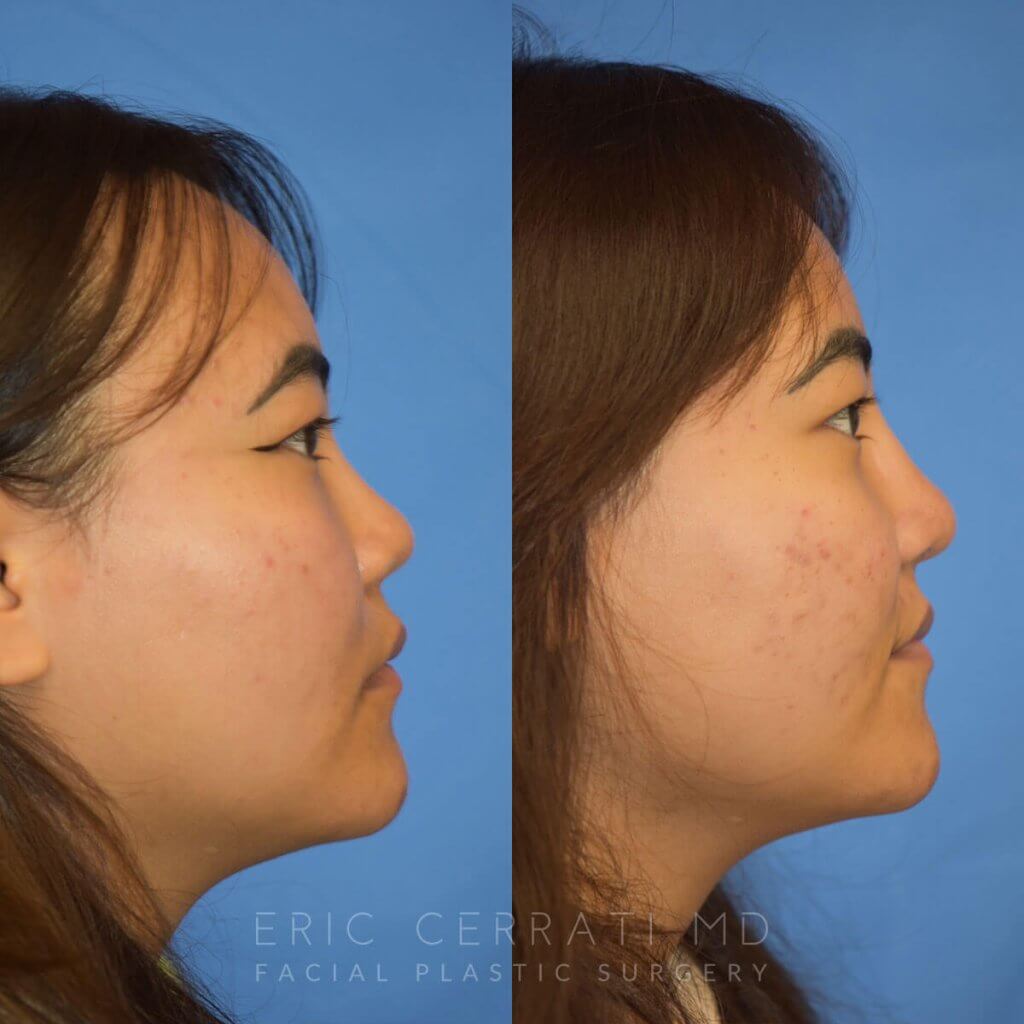 Female patient before and after rhinoplasty