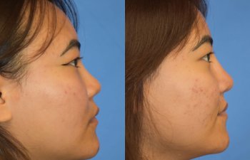 Female patient before and after rhinoplasty