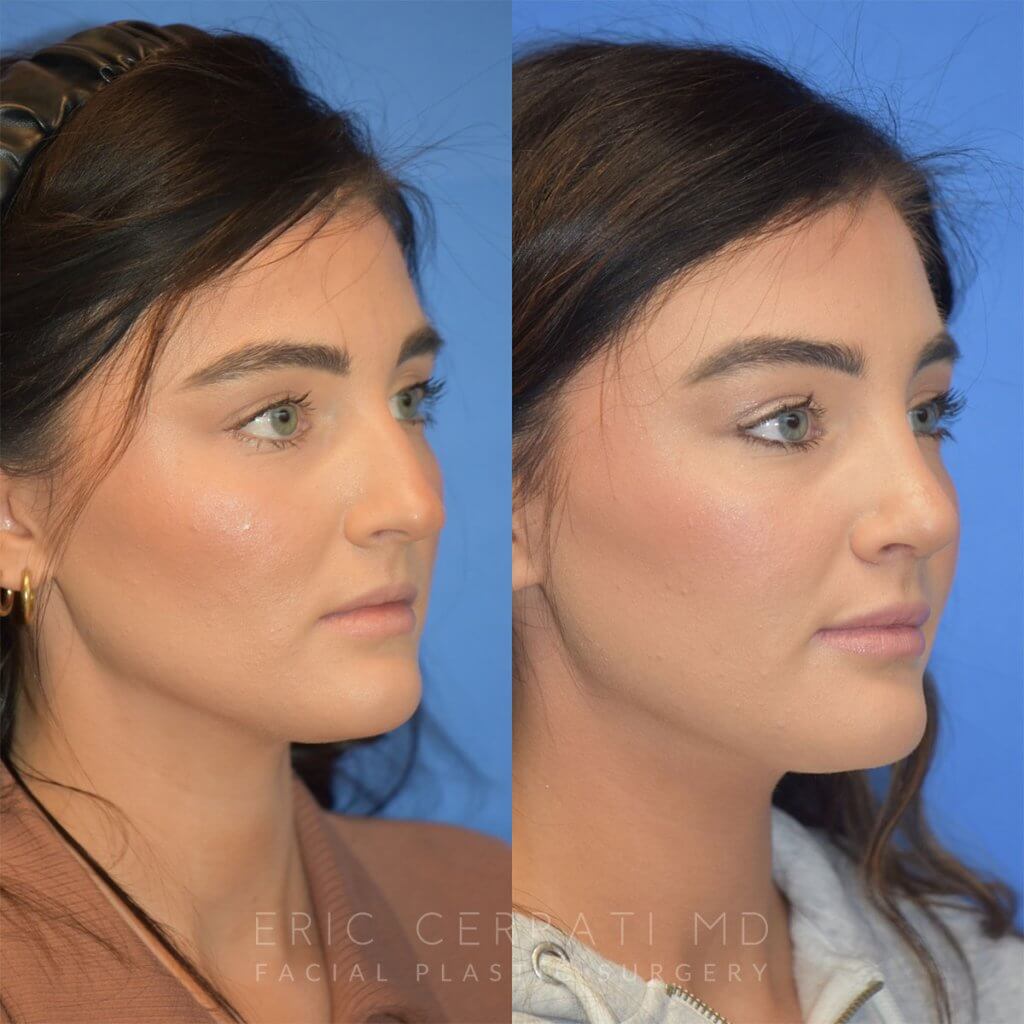 Female patient before and after rhinoplasty