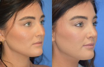 Female patient before and after rhinoplasty