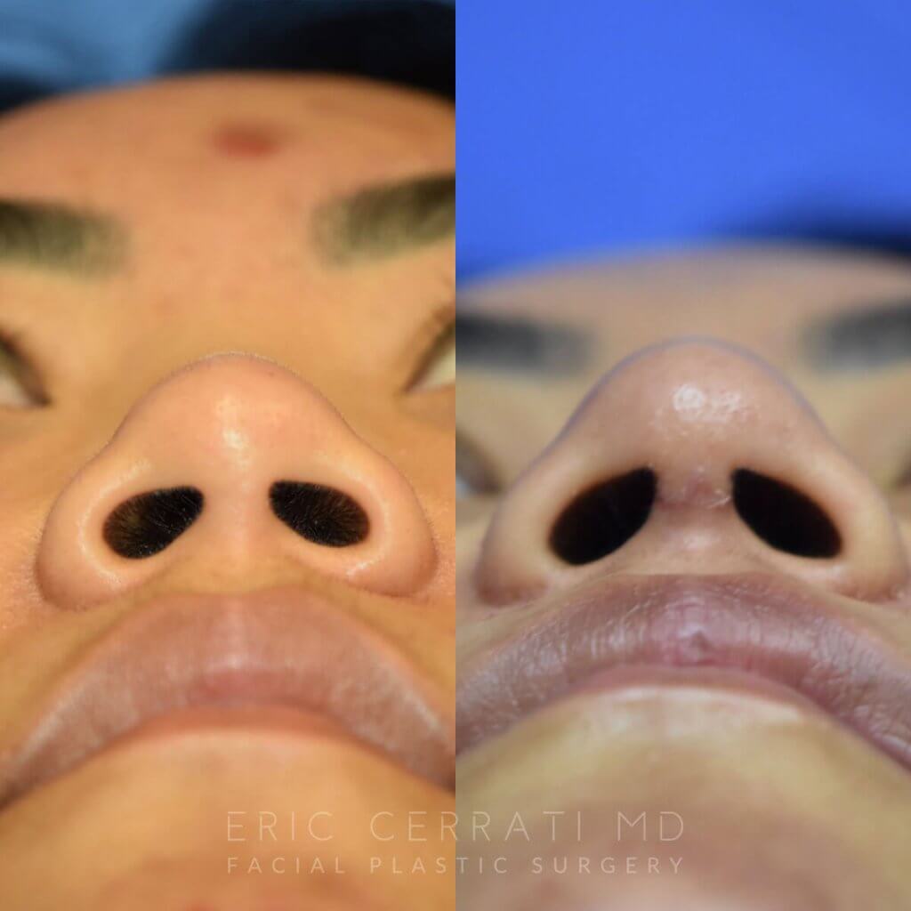 Female patient before and after rhinoplasty