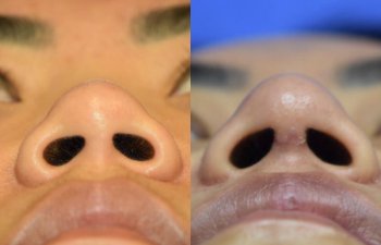 Female patient before and after rhinoplasty