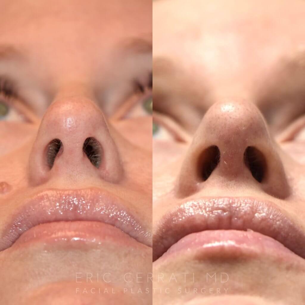 Female patient before and after face & rhinoplasty