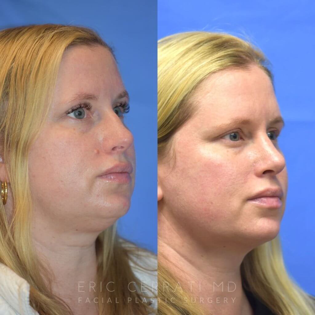 Female patient before and after face & rhinoplasty
