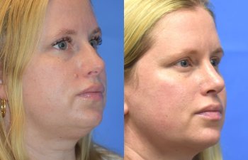 Female patient before and after face & rhinoplasty