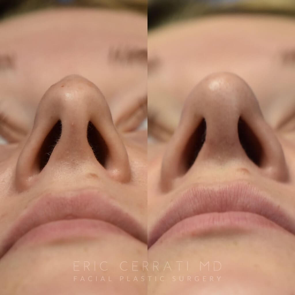 Female patient before and after face & rhinoplasty