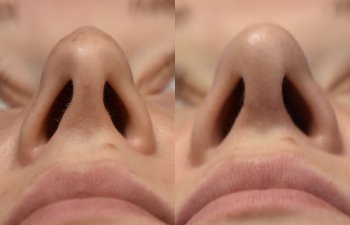 Female patient before and after face & rhinoplasty