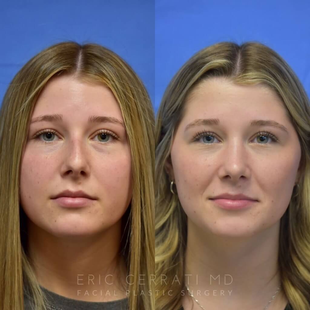 Female patient before and after face & rhinoplasty