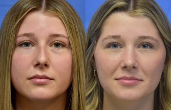 Female patient before and after face & rhinoplasty