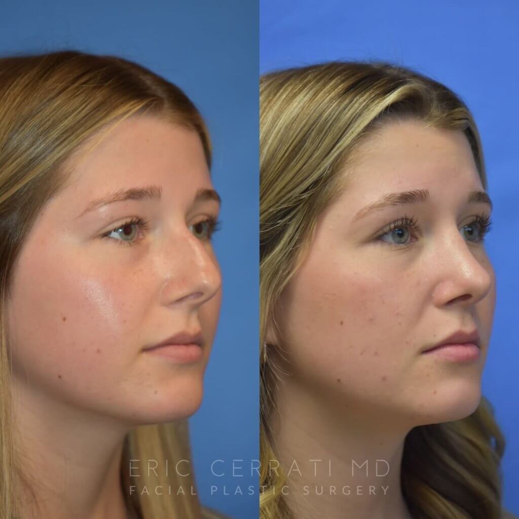 Female patient before and after face & rhinoplasty