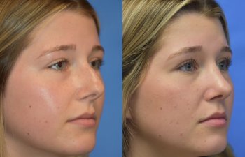 Female patient before and after face & rhinoplasty