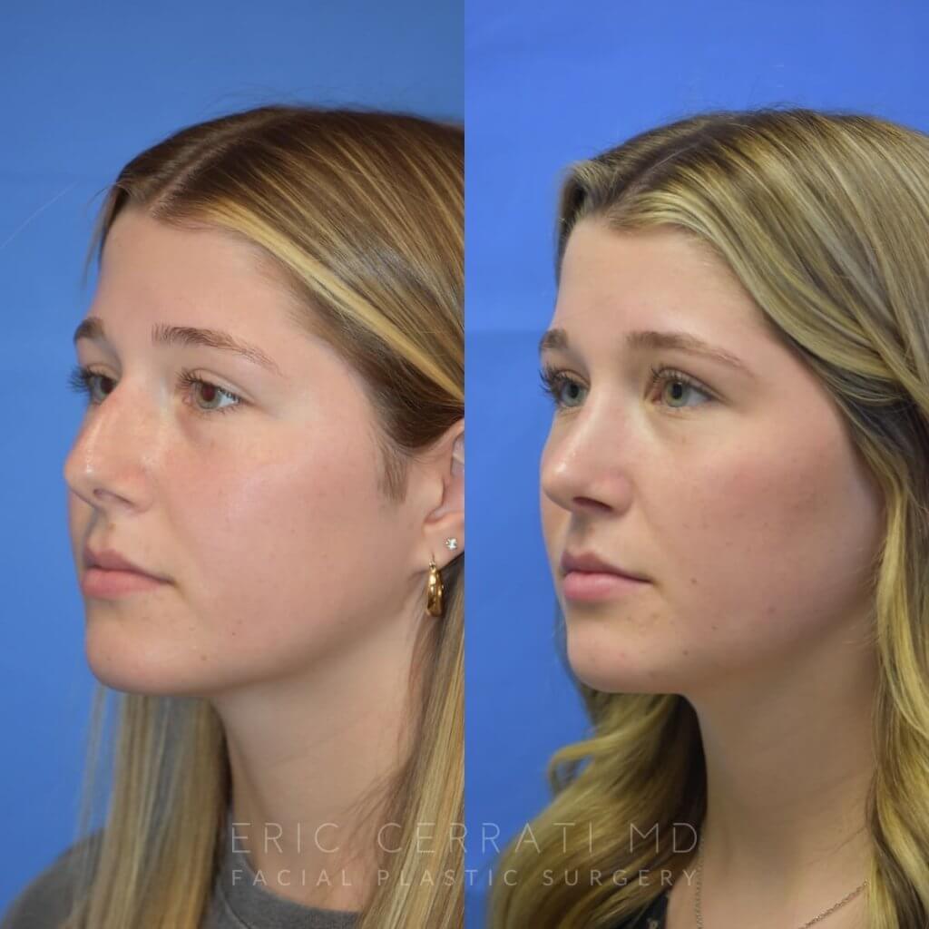 Female patient before and after face & rhinoplasty