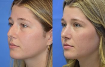 Female patient before and after face & rhinoplasty