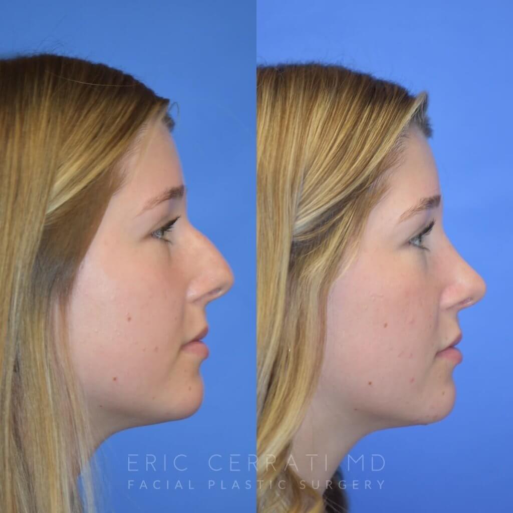 Female patient before and after face & rhinoplasty