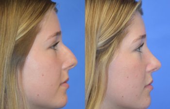 Female patient before and after face & rhinoplasty