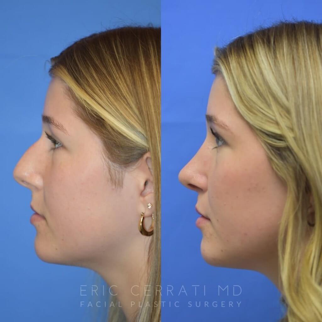 Female patient before and after face & rhinoplasty