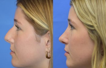 Female patient before and after face & rhinoplasty