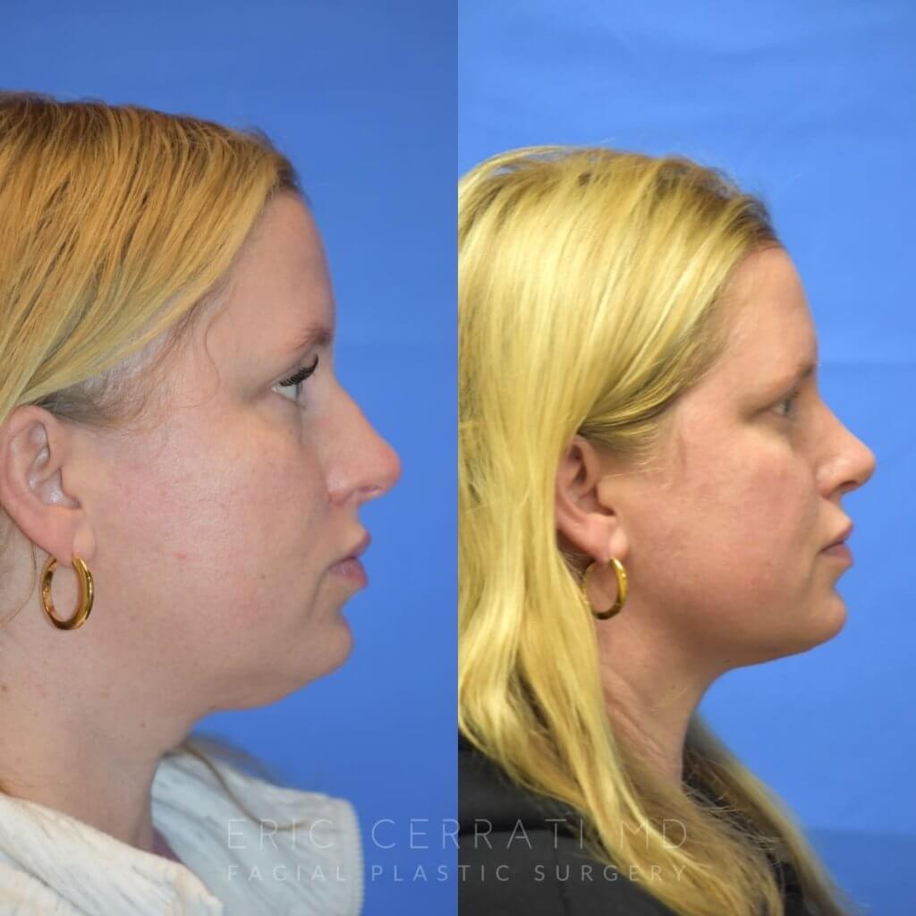 Female patient before and after face & rhinoplasty