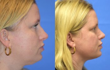 Female patient before and after face & rhinoplasty