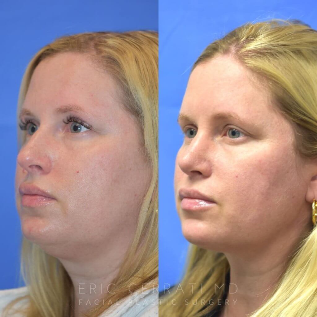 Female patient before and after face & rhinoplasty