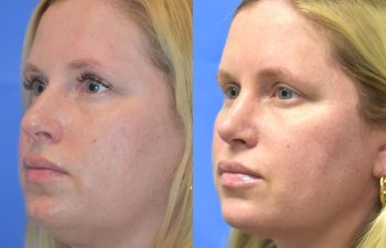 Female patient before and after face & rhinoplasty