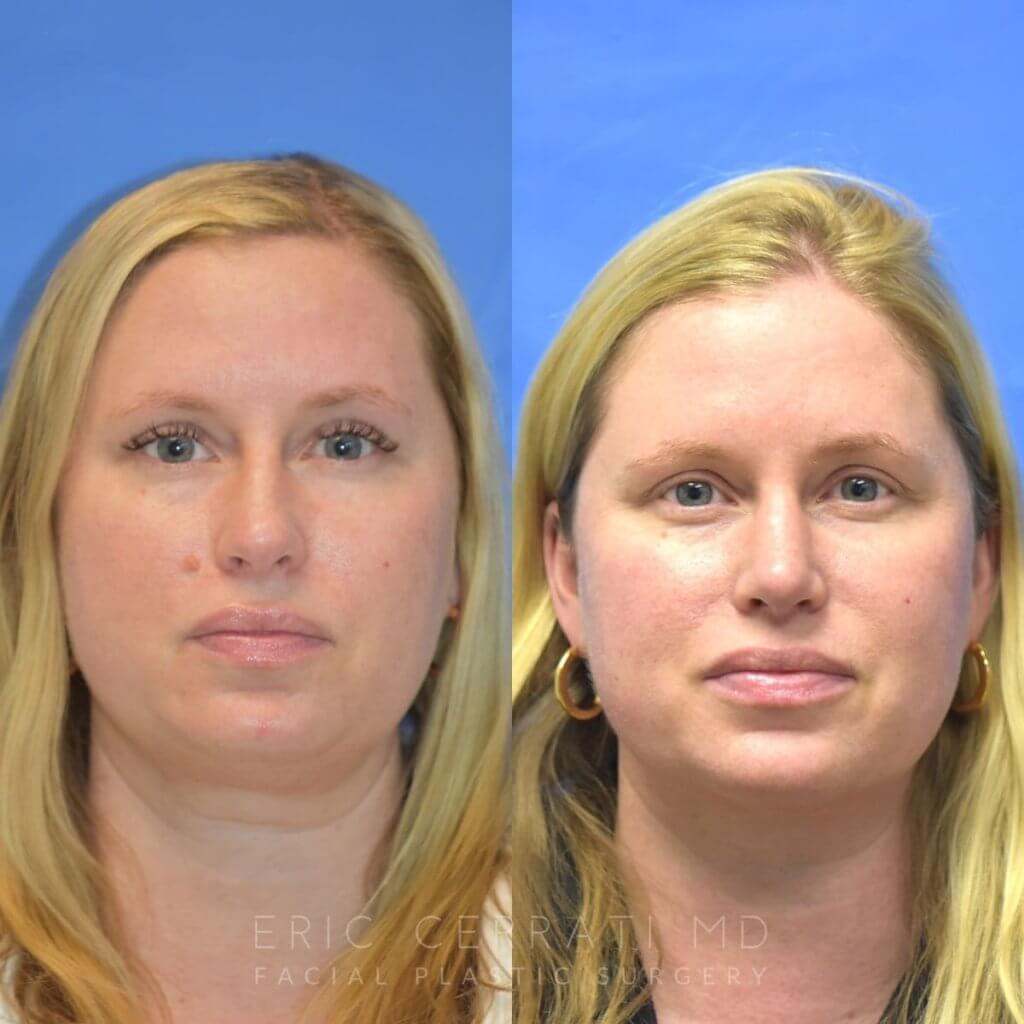 Female patient before and after face & rhinoplasty