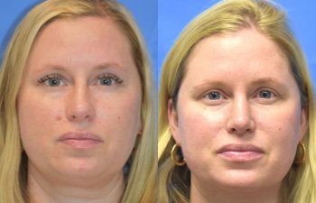 Female patient before and after face & rhinoplasty