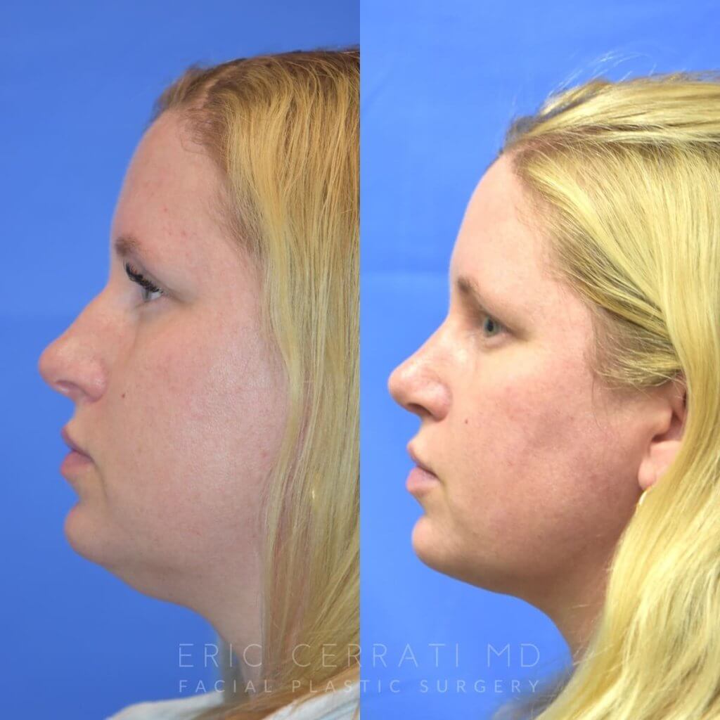 Female patient before and after face & rhinoplasty