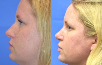 Female patient before and after face & rhinoplasty