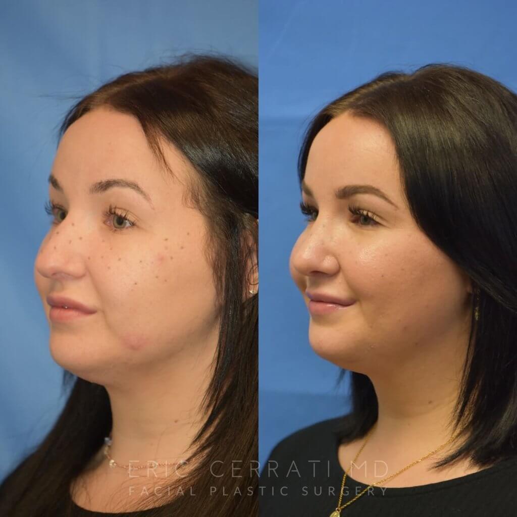 Female patient before and after rhinoplasty