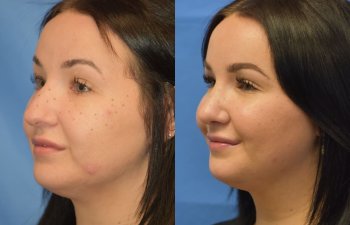 Female patient before and after rhinoplasty