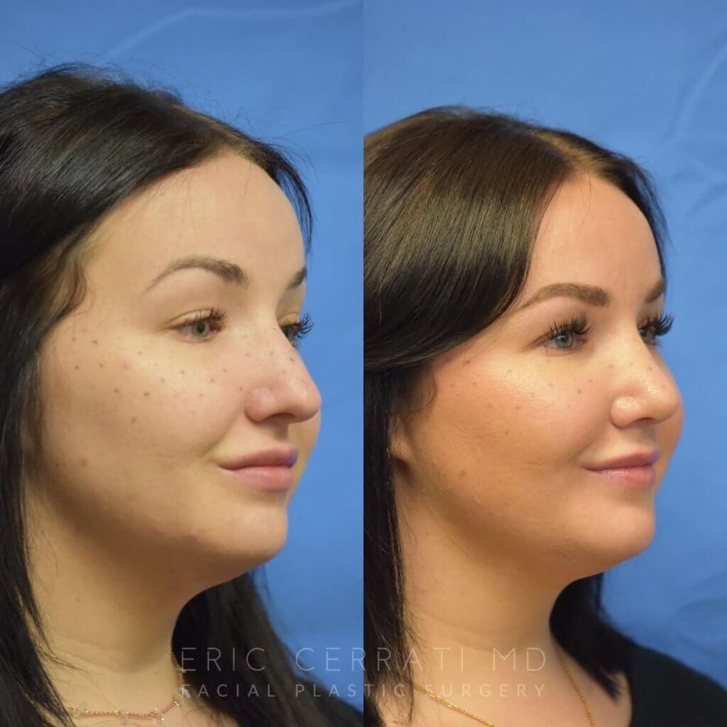 Female patient before and after rhinoplasty