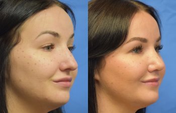 Female patient before and after rhinoplasty
