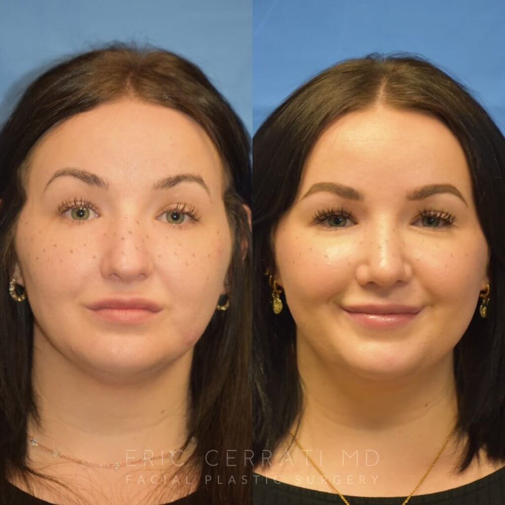Female patient before and after rhinoplasty