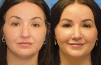 Female patient before and after rhinoplasty
