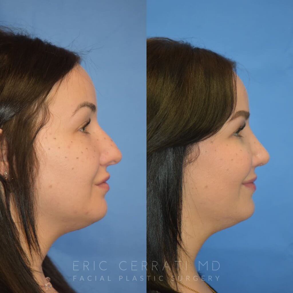 Female patient before and after rhinoplasty