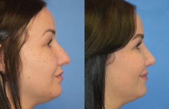 Female patient before and after rhinoplasty