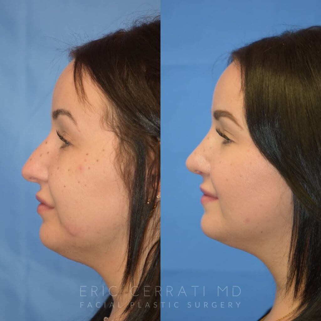 Female patient before and after rhinoplasty