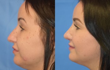 Female patient before and after rhinoplasty