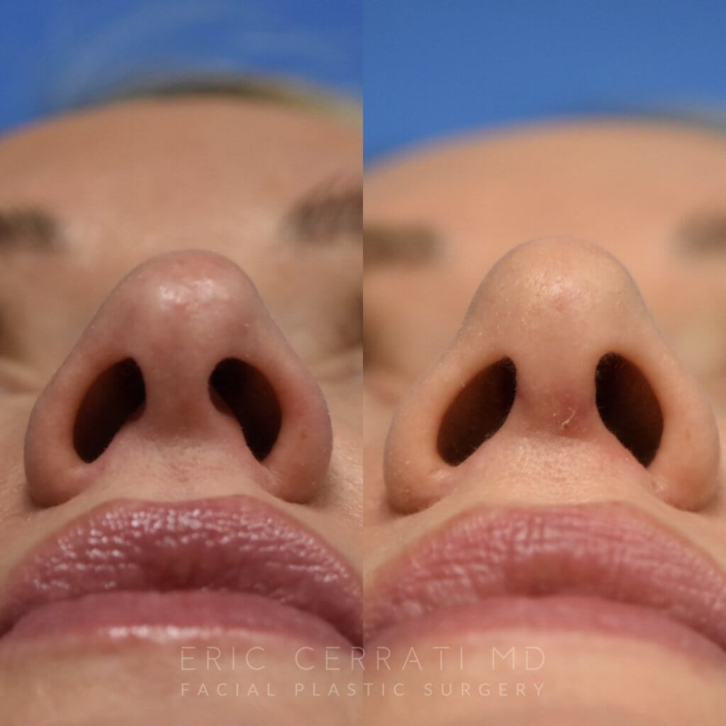 Female patient before and after rhinoplasty