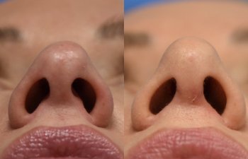 Female patient before and after rhinoplasty