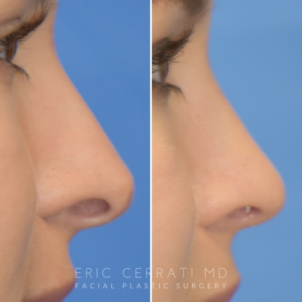 Female patient before and after rhinoplasty